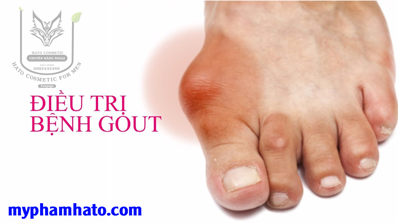 4. Các phương pháp điều trị bệnh gout